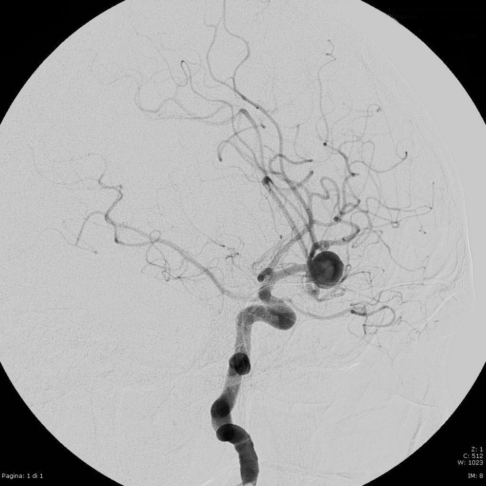 Aneurisma cerebrale angiografia pre operatoria Dott Andrea Barbanera